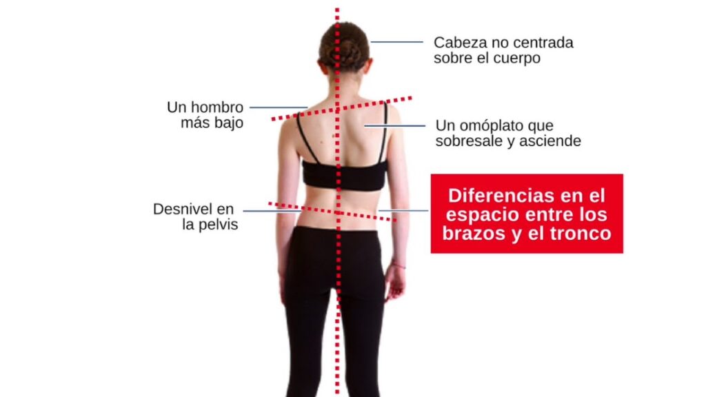 fisioterapia escoliosis Madrid