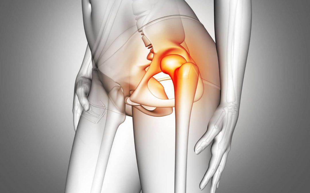 Fisioterapia para prótesis de cadera