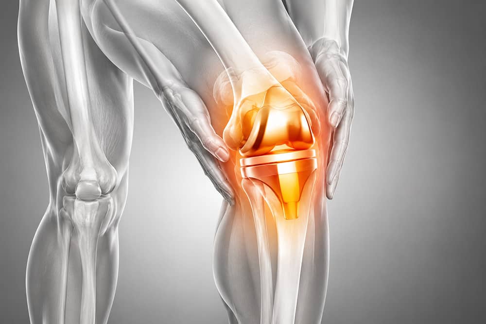 Rehabilitación de Prótesis de Rodilla